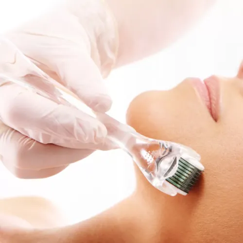 Microagujas (Microneedling)